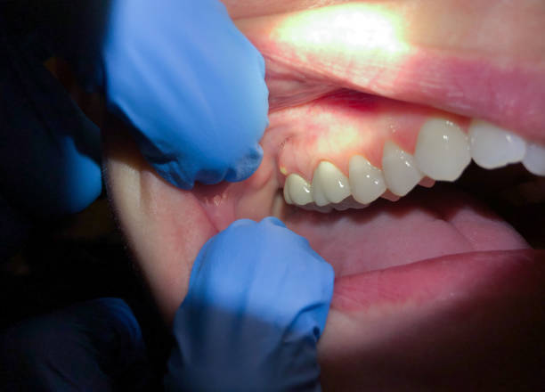 Best Emergency Broken Tooth Repair in Drexel, OH